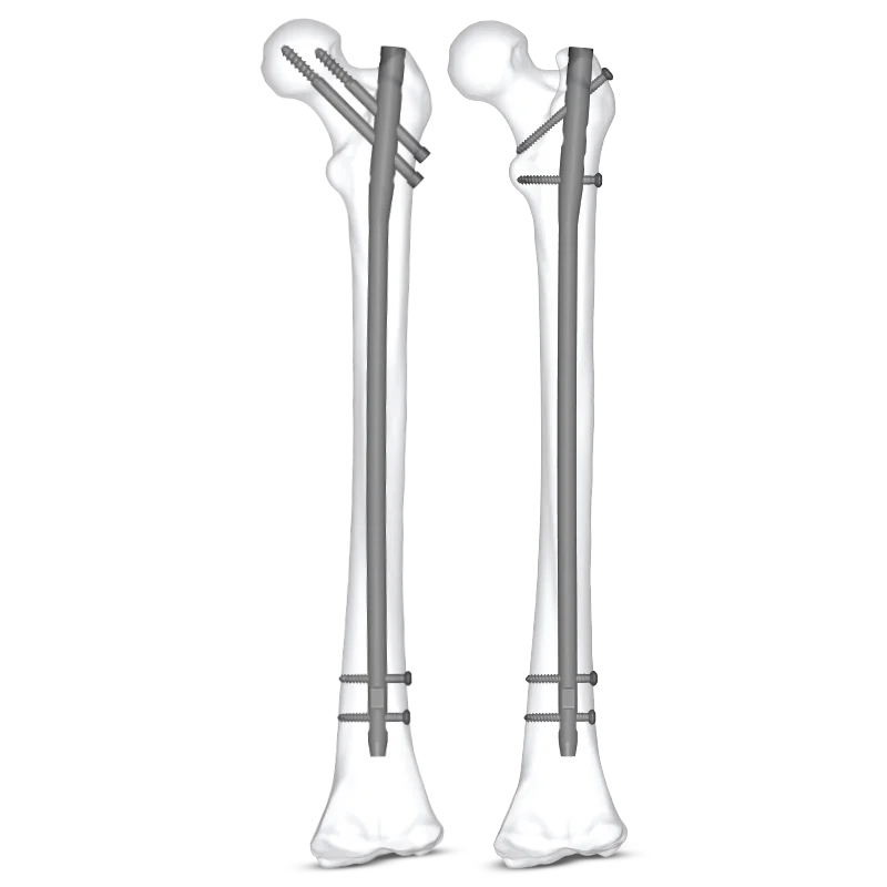 Expert Femur Nail with Bone