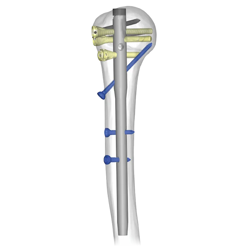 Humeron™ Multifix Humeral Nail