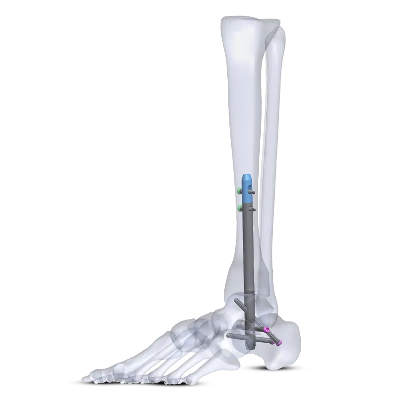 Tarsofix™ Ankle Nailing System