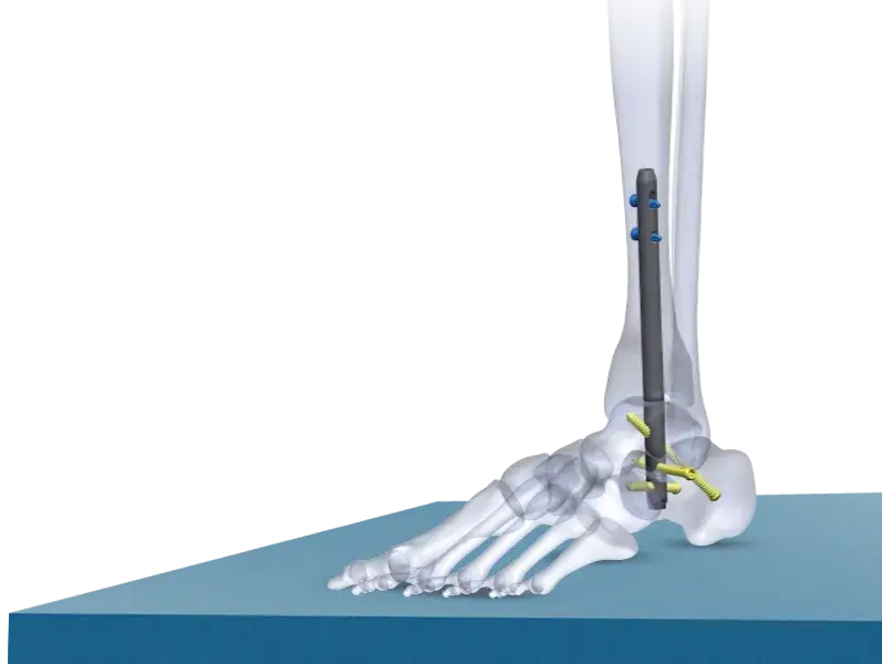 Tarsofix nail with bone