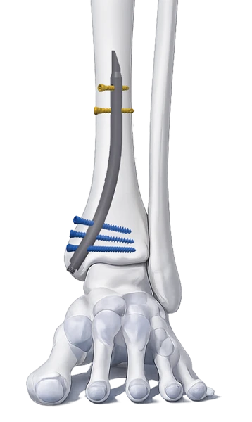 DISTLON Nail in bone