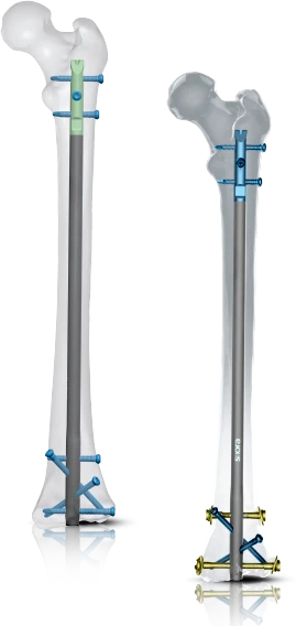 rigifix with bone
