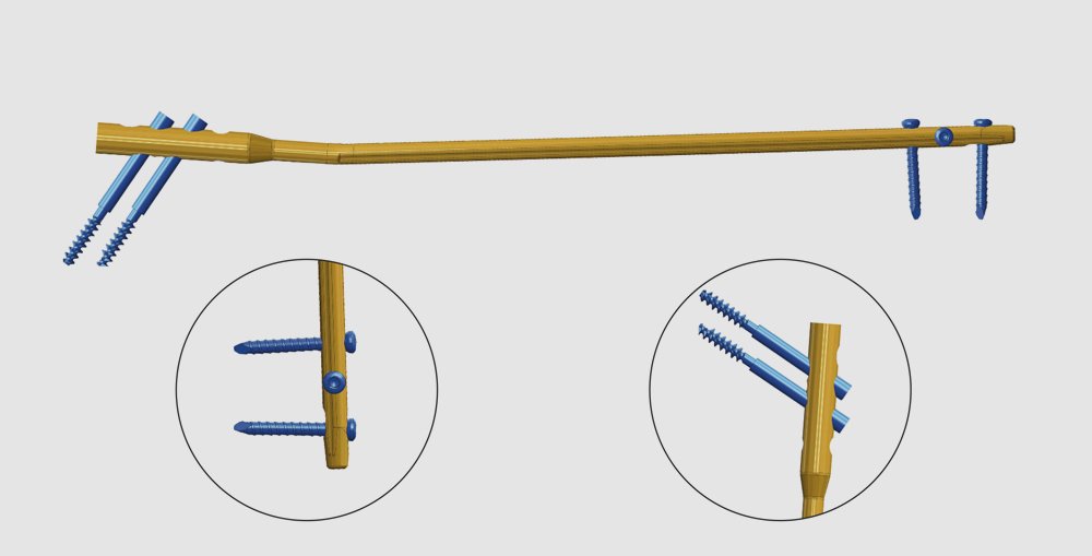 Use of Orthopedic Rods with Locking Aperture