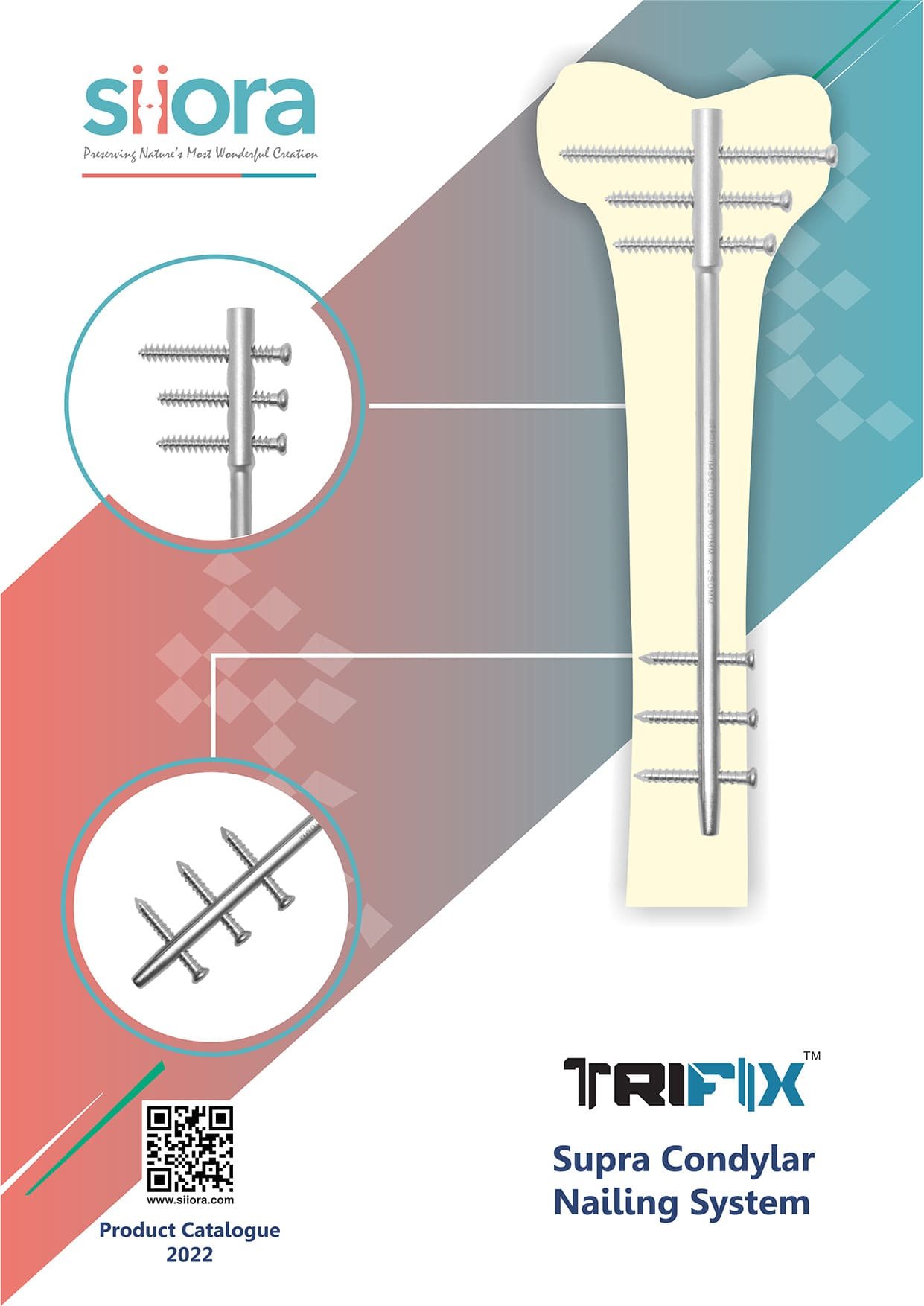 trifix supra condylar nailing system