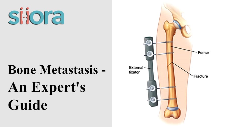 Bone Metastasis - An Expert's Guide