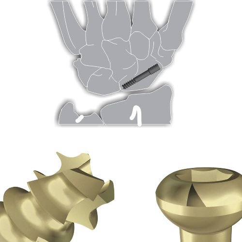 Cannulated Screws