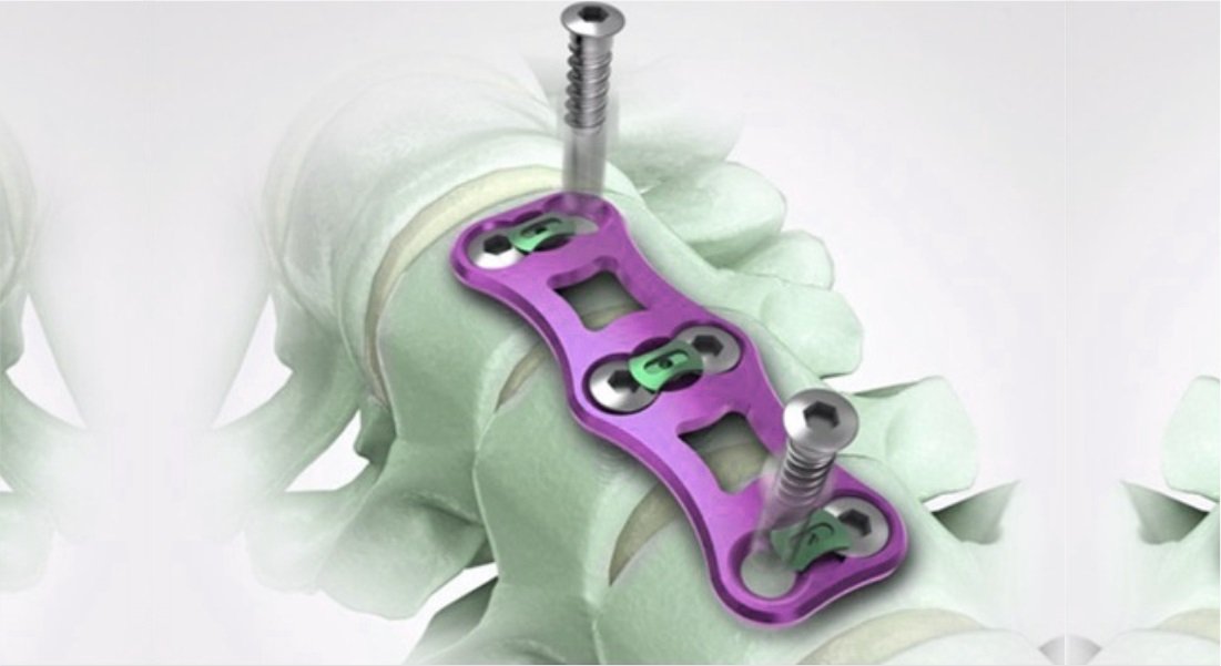 Cervical Implants Used in Spine Surgery