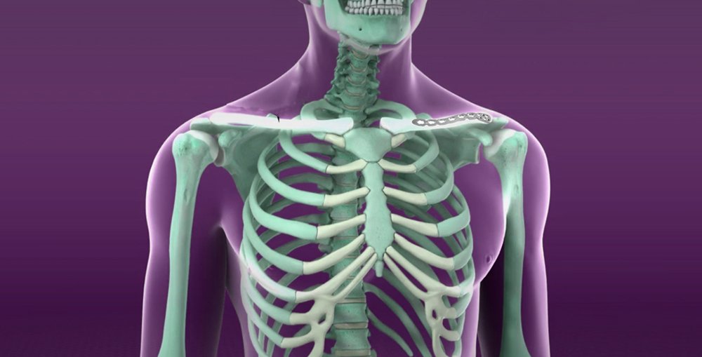 Clavicle (Collarbone) Fractures Treatment