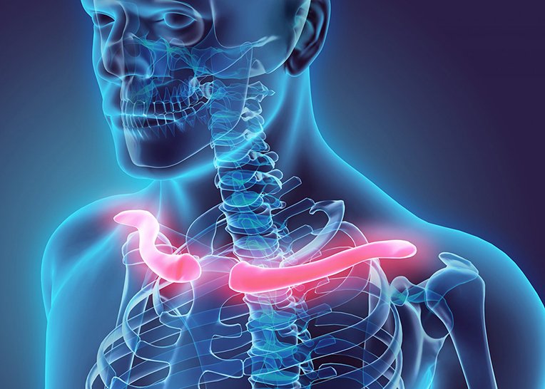 Collarbone Fractures Diagnosis Causes And Treatment