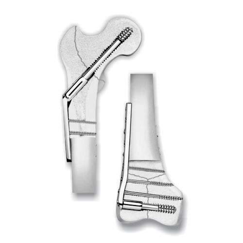 DHS / DCS Implants & Instruments