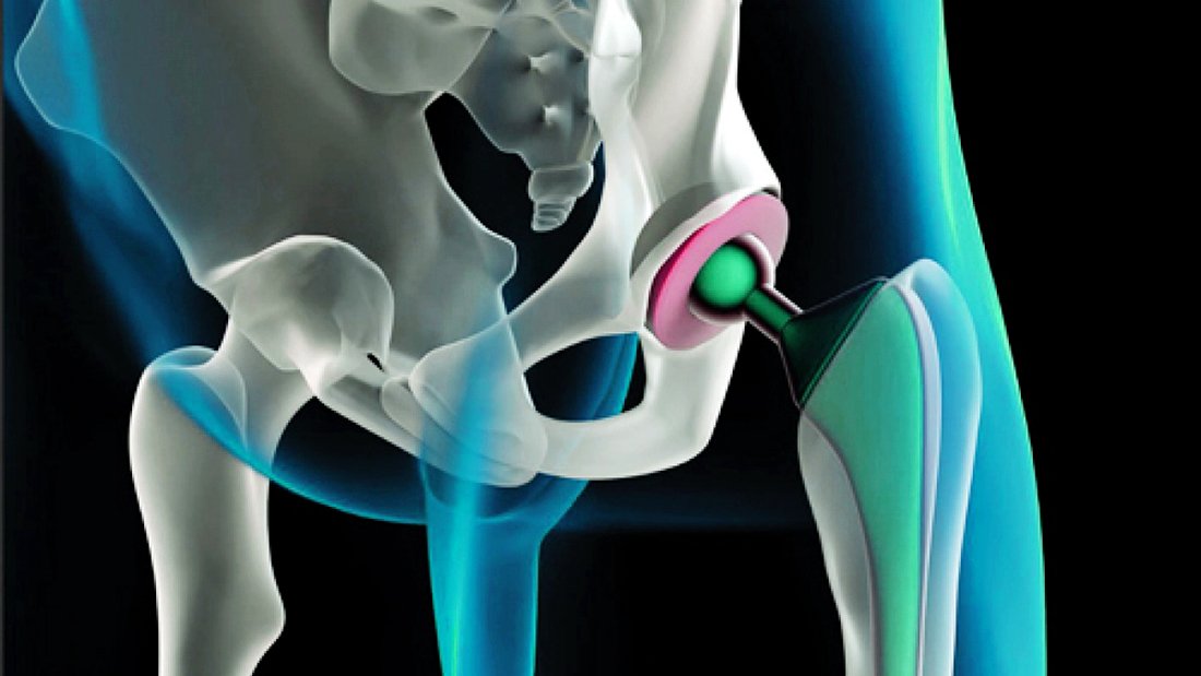 Do You Know About Hip Fracture