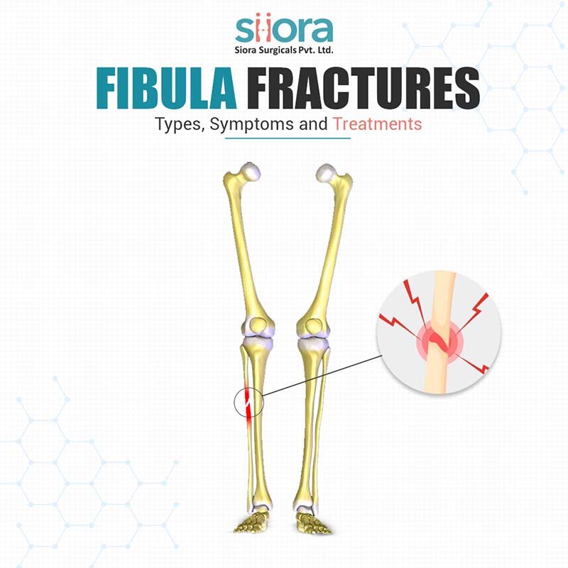 Read more about the article Fibula Fractures: Types, Symptoms & Treatment