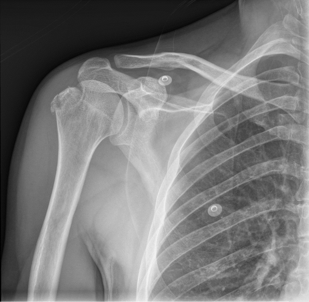 Fracture Of The Upper End Of Humerus