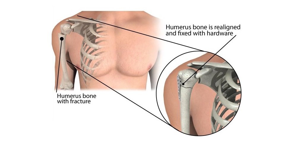 Humerus Fracture