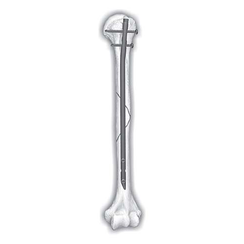 Humerus Interlocking Nailing System