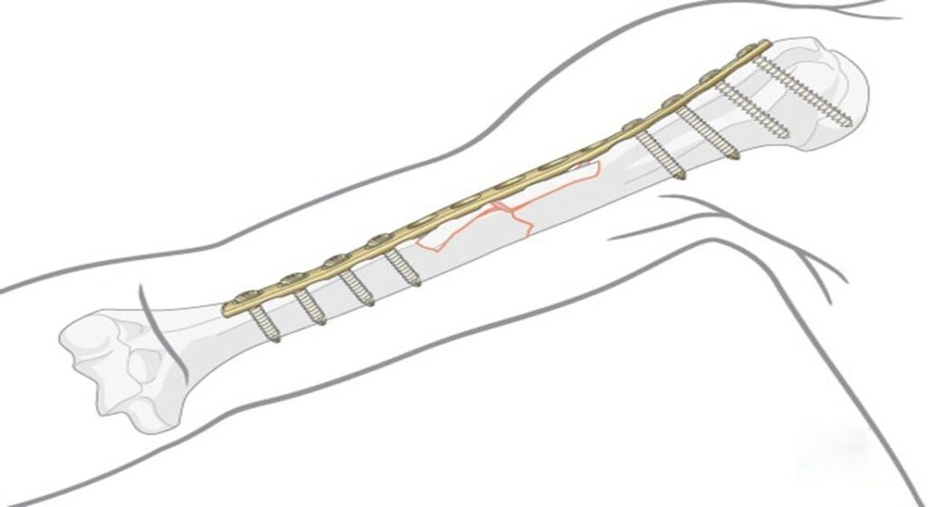 Kinds of Modes of Bone Plating