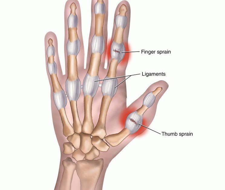 Thumb Sprain Symptoms & Treatment