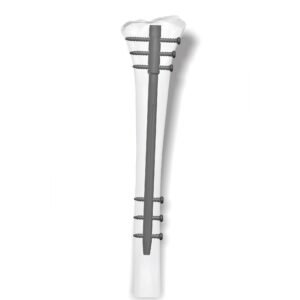 Trifix Supra Condylar Nailing System