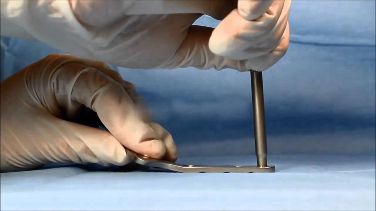 What are the General Principles of Plate Fixation