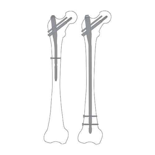 TFN / PFN Nailing System