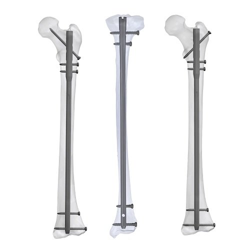 Tibia & Femur Nailing System