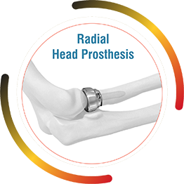 Radial Head Prosthesis