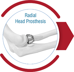 Radial Head Prosthesis