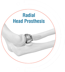 Radial Head Prosthesis