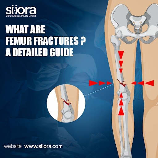 What Are Femur Fractures? A Detailed Guide