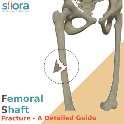 Femoral Shaft Fractures