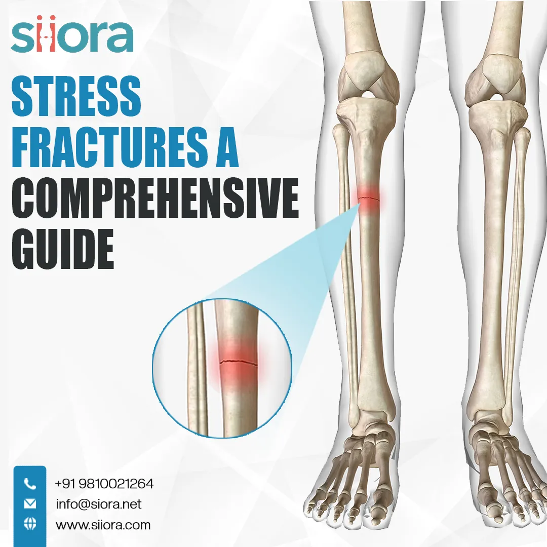 Stress Fractures - A Comprehensive Guide