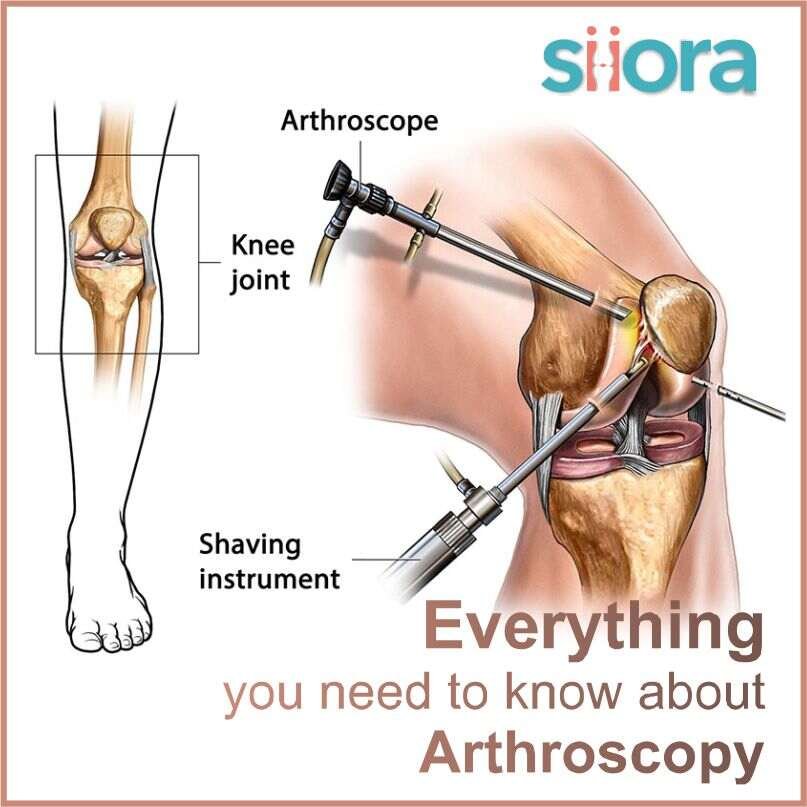 Arthroscopy