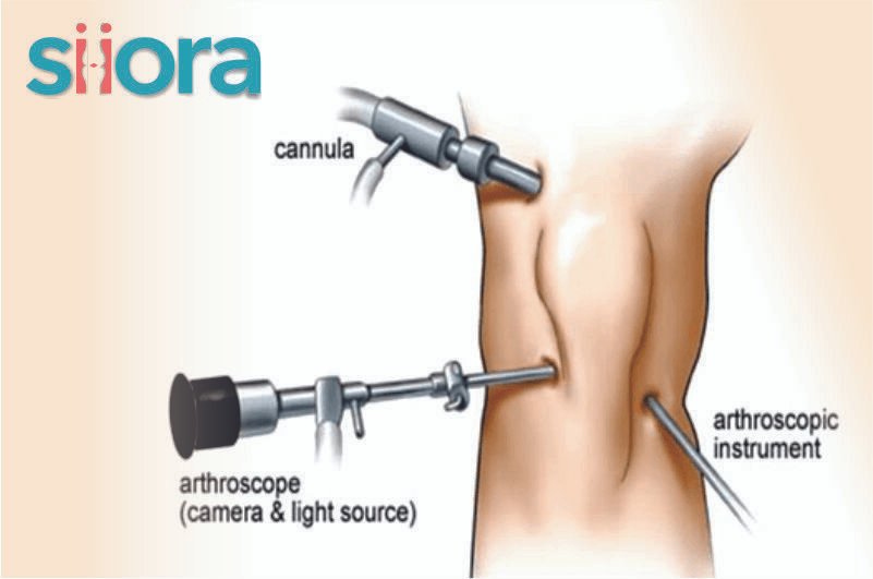 Arthroscopic Surgery