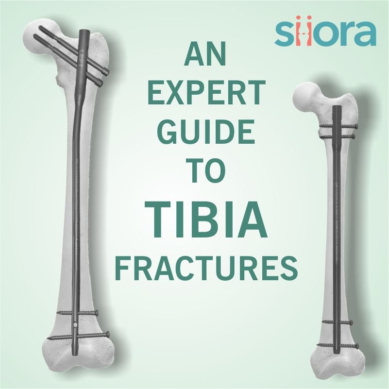 Tibia Fractures