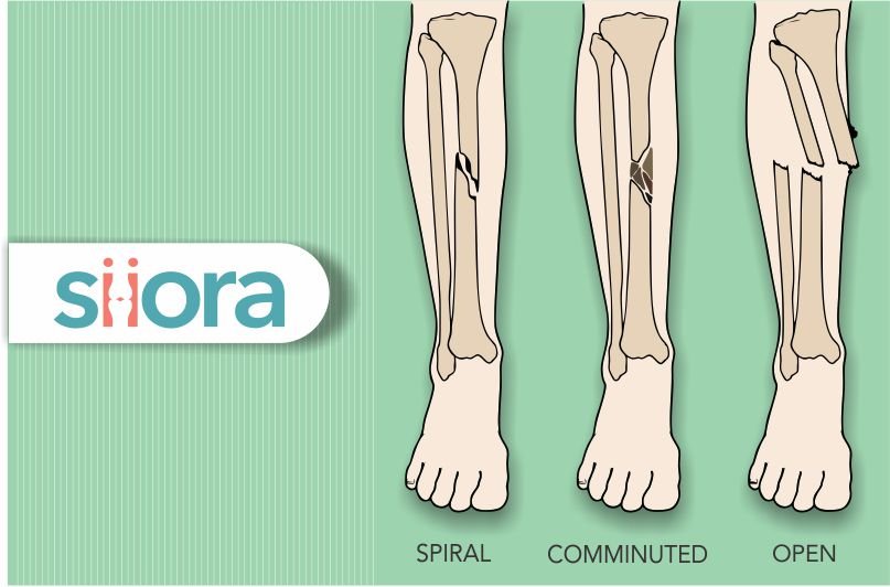Tibia Fractures