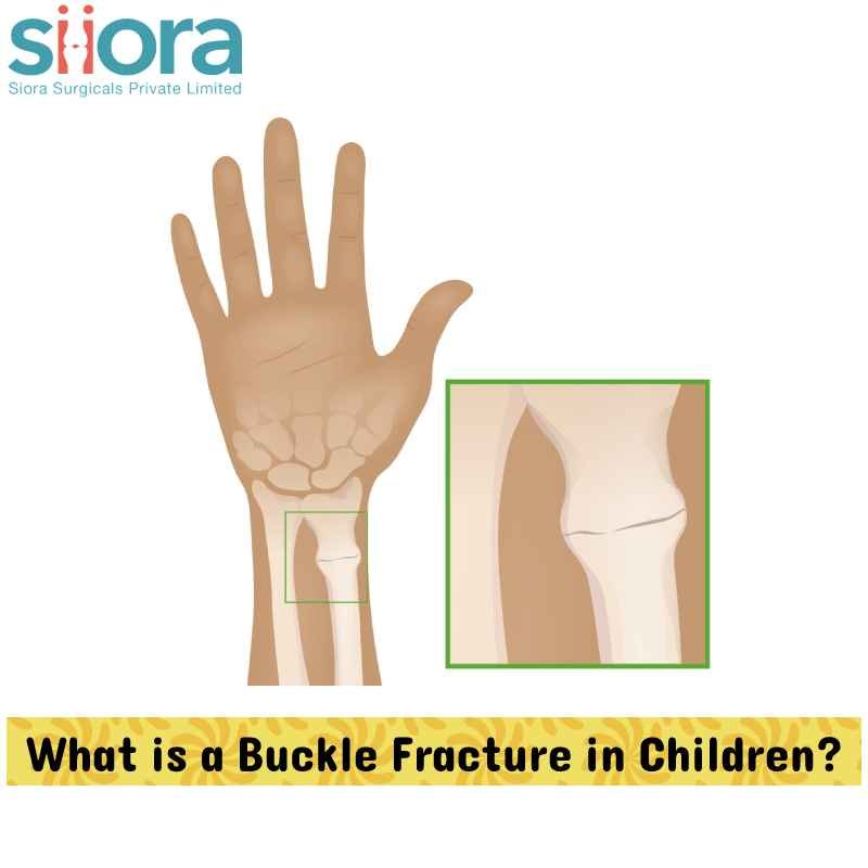 Buckle Fractures