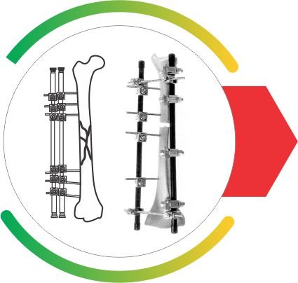 External Fixator System