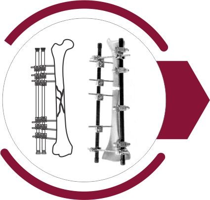 External Fixator System