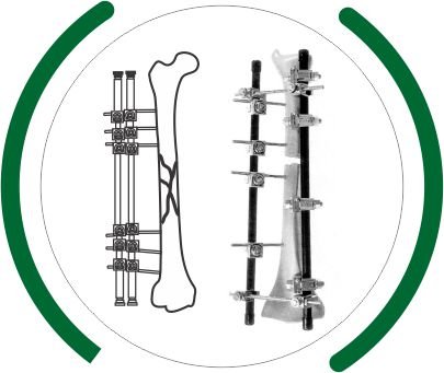 External Fixator System