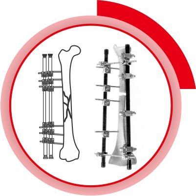 External Fixator System