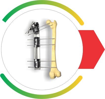 Zailfix LRS Ex-Fix System