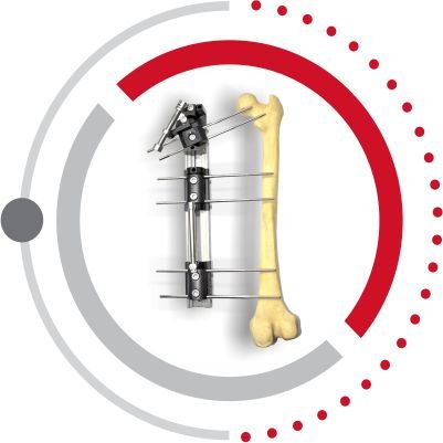 Zailfix LRS Ex-Fix System