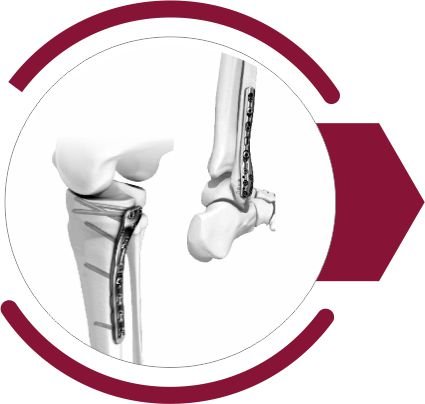 HELIX Locking Plate System