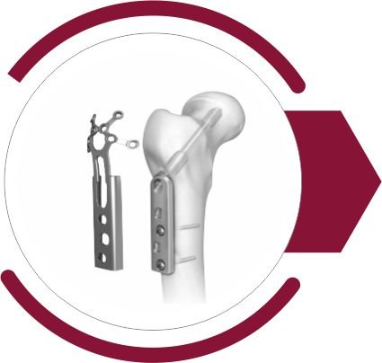 DHS/DCS Implants & Instrument