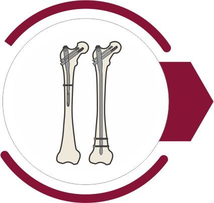 TFN / PFN Nailing System