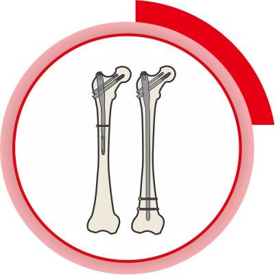 TFN / PFN Nailing System