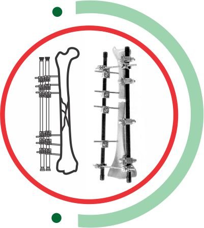 External Fixator System