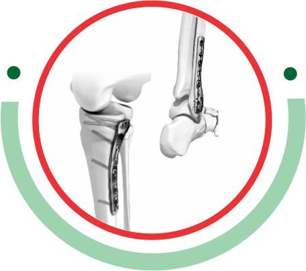 HELIX Locking Plate System