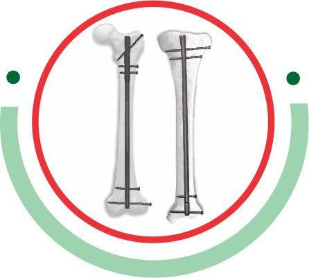 Tibia Femur Nailing System