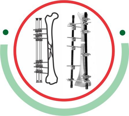 External Fixator System